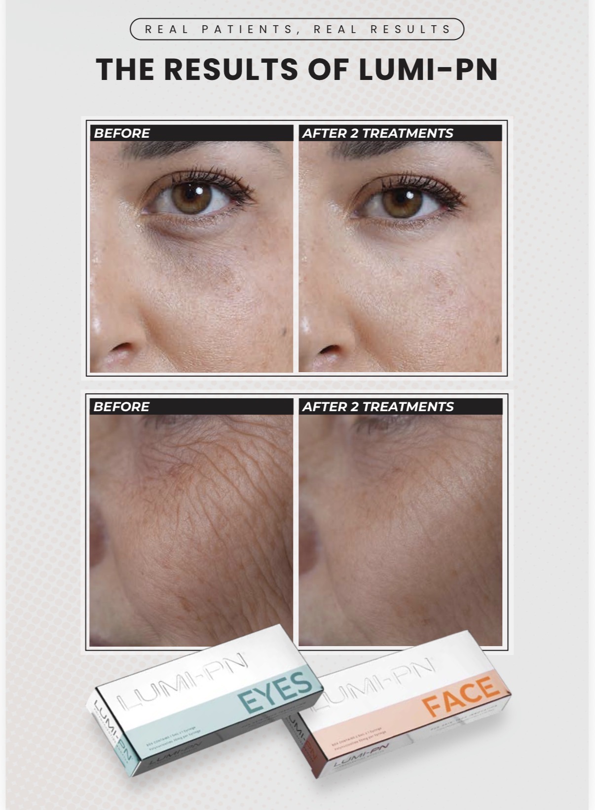 Lumi-PN Eyes — Before / After