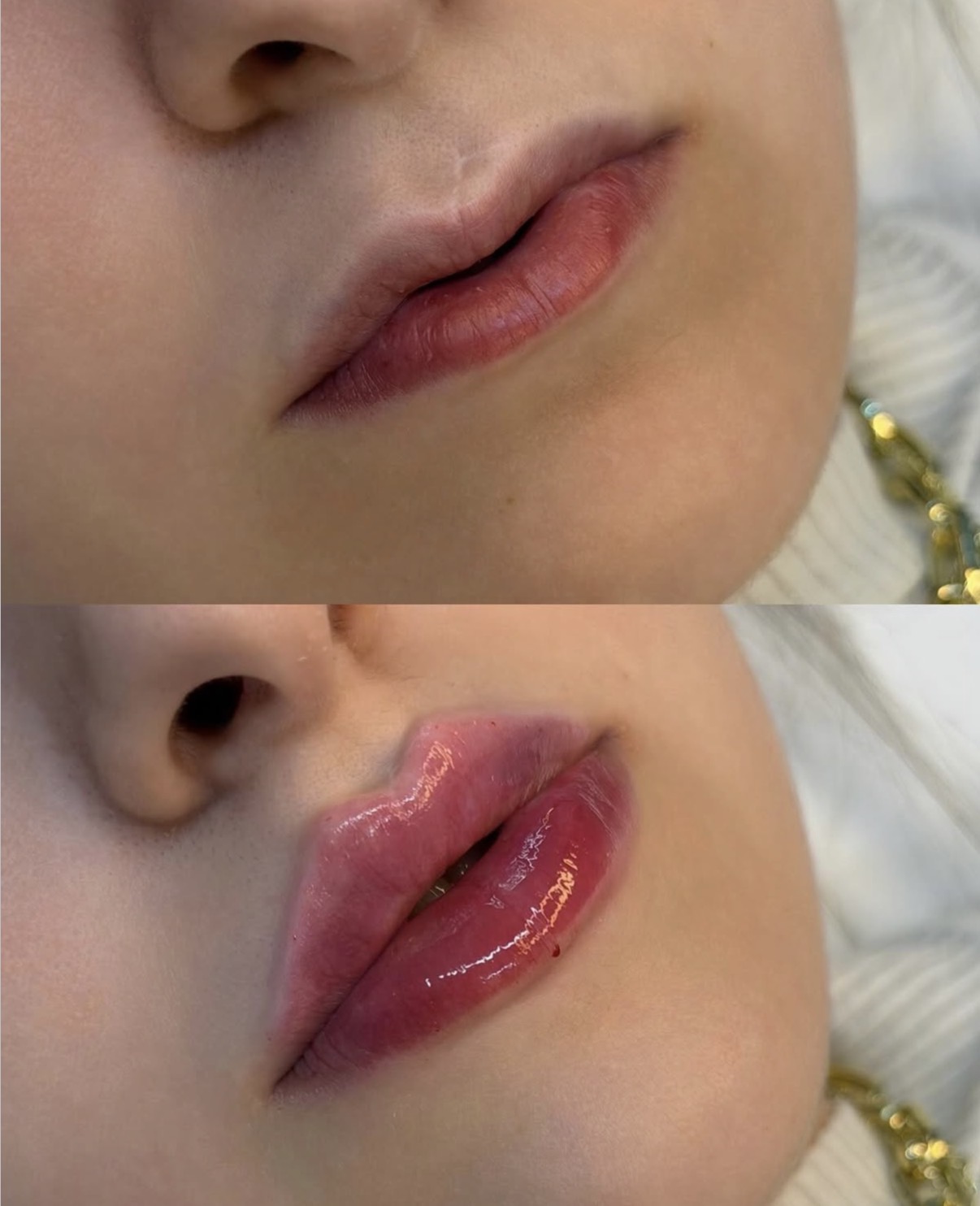 Lumifil L Kiss — Before / After