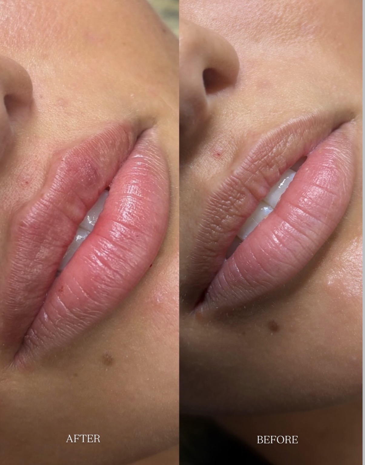 Lumifil L Lite — Before / After