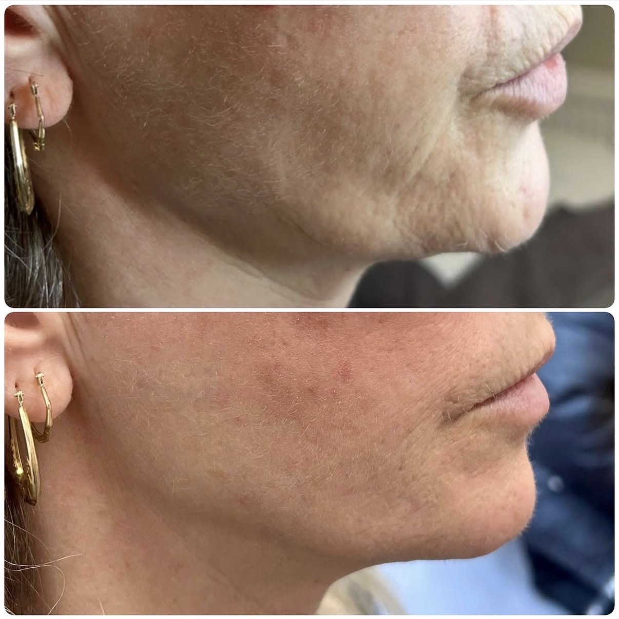 Lumifil L Max — Before / After
