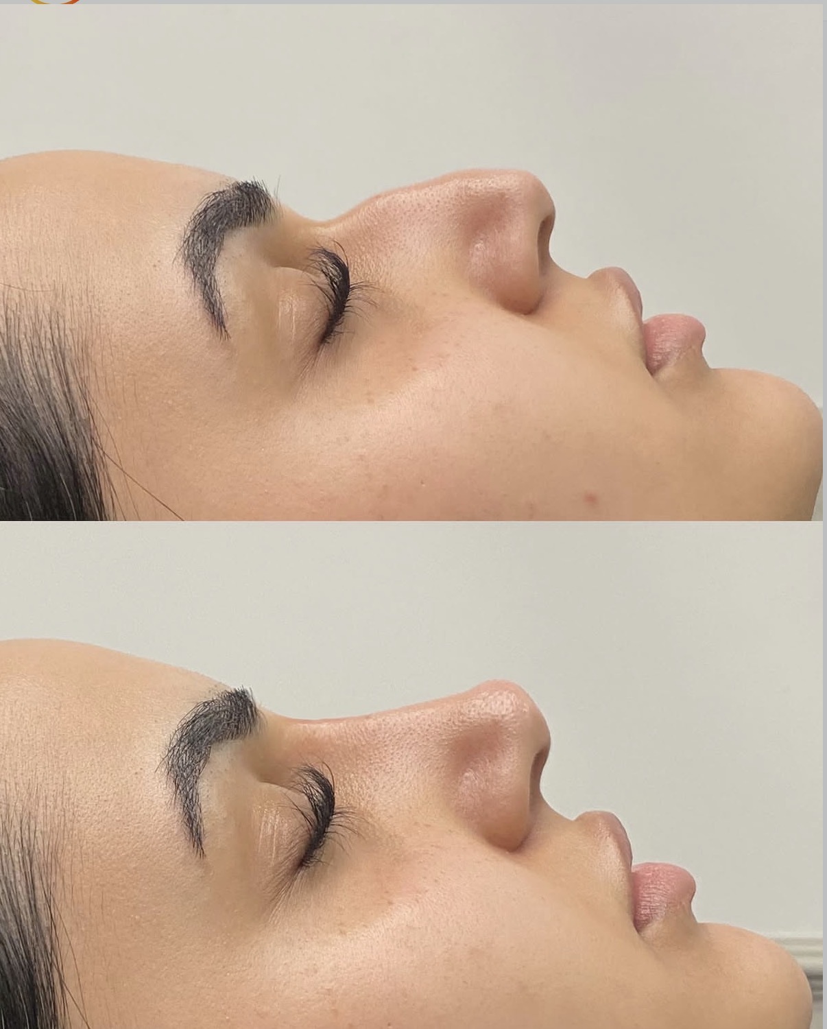 Lumifil L Max — Before / After